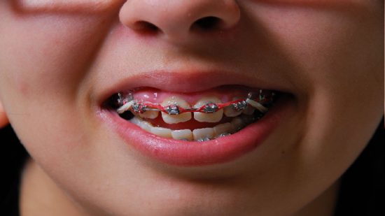 Tips Before Going for Emergency Dentistry in Upatoi, GA