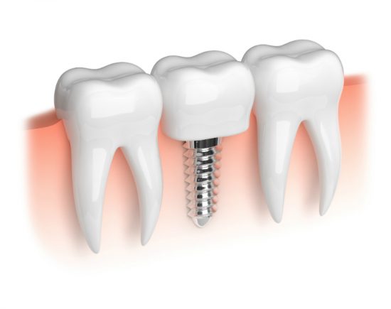 Should You Get Dental Implants in Charleston SC Or Dentures?